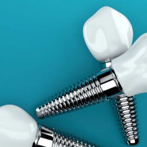 Implantes en Clínica Dental Altea