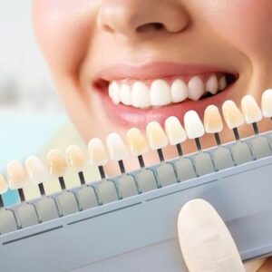 Blanqueamiento Clínica Dental Altea