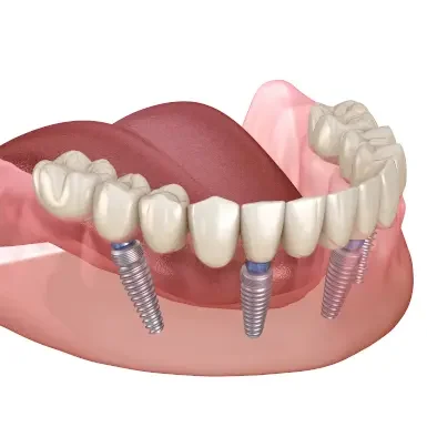 Имплантаты ALL-ON-4®
