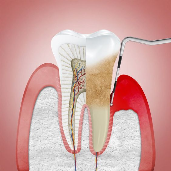 Periodoncia